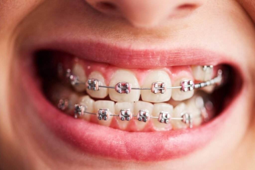 Dental Braces