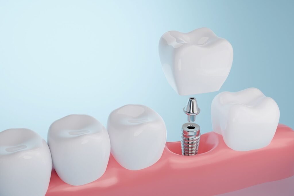 Dental implants